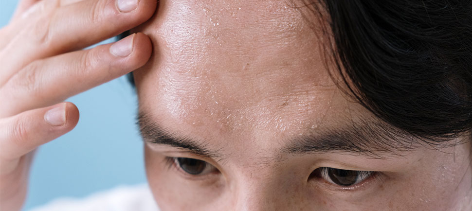 photo-showing-sweating-which-is-a-part-of-withdrawal-stage